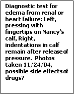 Text Box: Diagnostic test for  edema from renal or heart failure: Left, pressing with finger-tips on Nancy‘s calf, Right, indentations in calf remain after re-lease of pressure.  Photos taken 11/24/04, possible side effects of drugs?